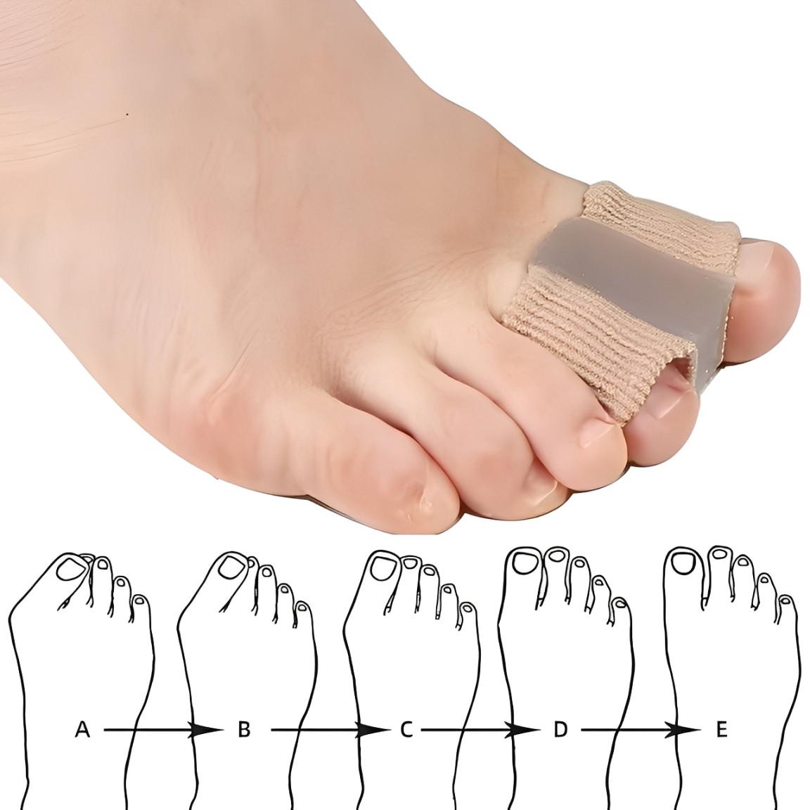 Séparateur d'Orteils Correcteur Hallux Valgus (lot de 2)